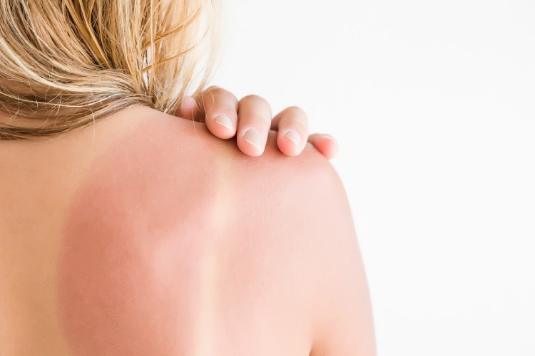 types of pain sunburn