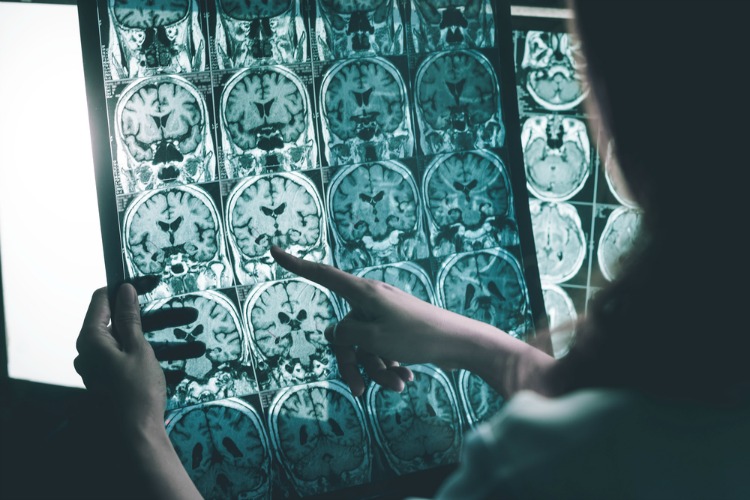 Cannabis for Alzheimer's brain scans